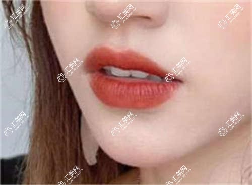贵阳安特高种植体是多少?4868元可做,术前指南教你不被坑