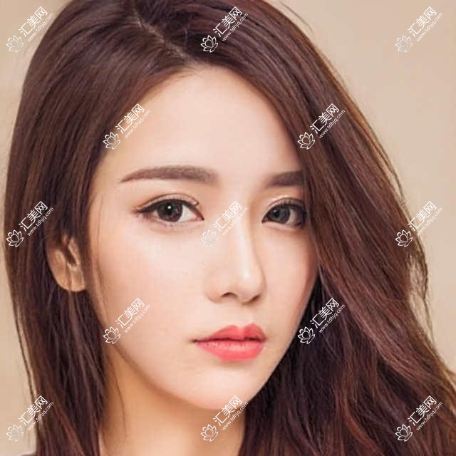 成都市懿和唯美医美门诊部拉皮眉弓项目费用揭秘？拉皮约2W+ 眉弓填充1W5+ 套餐3K+