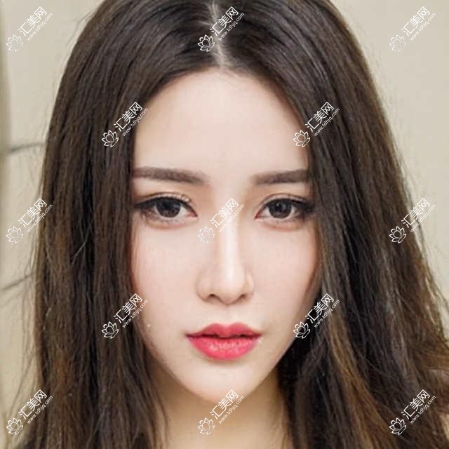 贵阳国内视达佳智慧散光片(SA)角膜塑形镜是多少?贵阳国内普诺瞳基弧球面T系列散光/美国欧几里得(Euclid)散光片角膜塑形镜/韩国露晰得(Lucid)散光片角膜塑形镜收费便宜