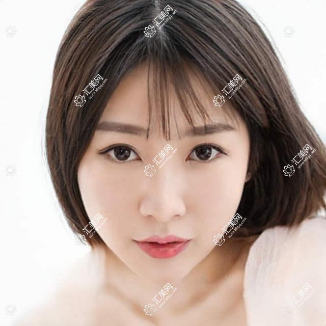 临沂玻尿酸丰面颊多少钱?胶原蛋白填充丰面颊4.5千+