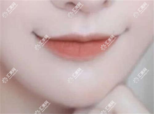 深圳眼部精细整形医生李鹏梁晓健徐英评测,专注美眼自然无痕