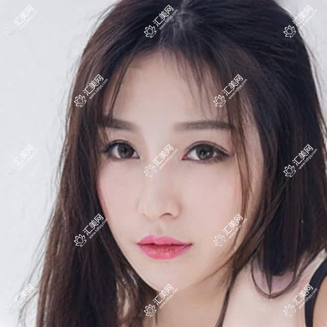 哈尔滨上睑提肌多少钱?2025价目表发布了~哈尔滨上睑提肌收费价格马上看!
