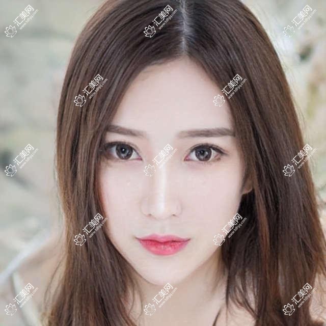 滁州整形医生姚广东沈干张琪擅长祛眼袋隆鼻等美容手术，疗效如何？
