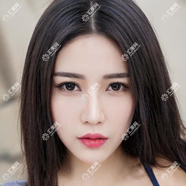 广州美莱医美揭秘:热门医美项目如玻尿酸、光子嫩肤价格全览