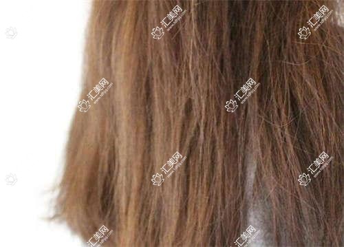 南宁找郑茜匀陈蒙梁勇医生做屈光眼科手术,视力迎新篇章
