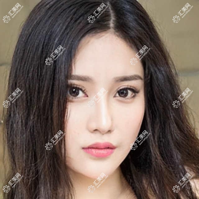 深圳市深西爱尔眼科散光度数矫正费用揭秘?全飞秒近视手术近2W/微雕半飞秒约1.5W/ICL晶体植入超3W