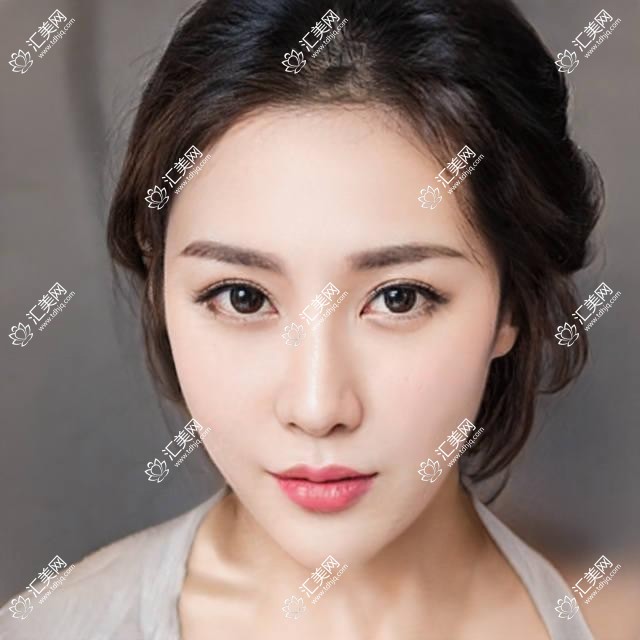 广州健丽眼袋医院价格表详解:双眼皮手术