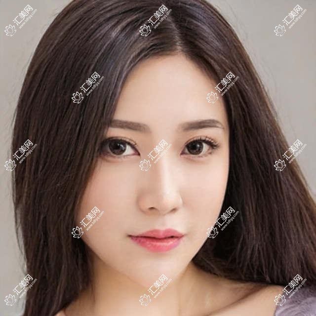 找威海张忠伟等眼科医生做眼部整形,眼睛更显魅力