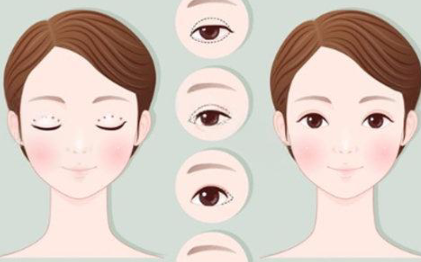 李瑞萱和石恒做双眼皮的适配人群