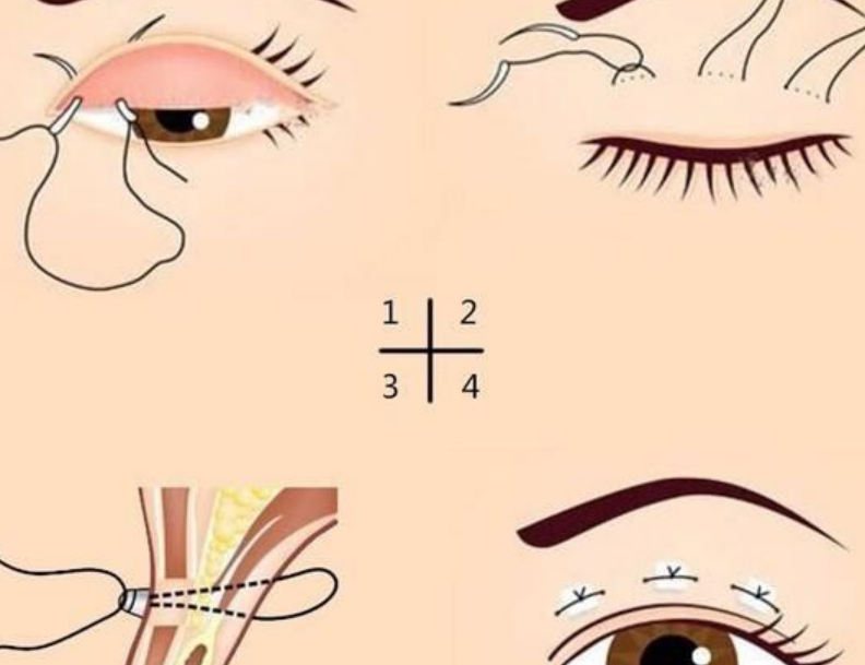 铃铛线和线雕的区别到底在哪？材质差异+效果维持时间全解析！