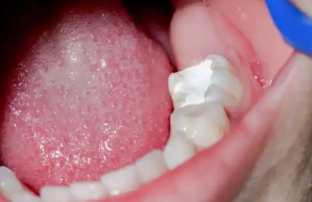 银汞补牙能做核磁吗？2026年权威数据：99%患者检查无异常