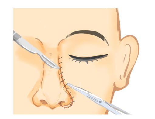 段焘隆鼻很自然吗？超自然款技术揭秘：8C骨雕+AI设计让假体隐形