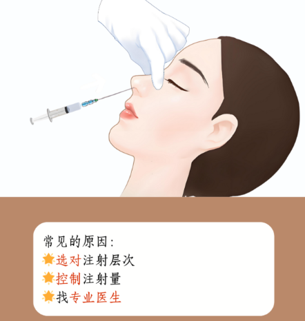 段焘隆鼻骨内推15000元无刀口，成都武侯区人民南路四段西区整形技术拆解