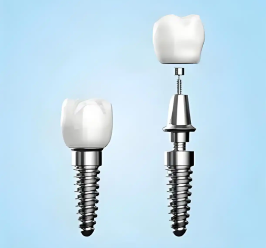 种植牙伤口多久愈合？一般7天左右恢复 拆线期别担心
