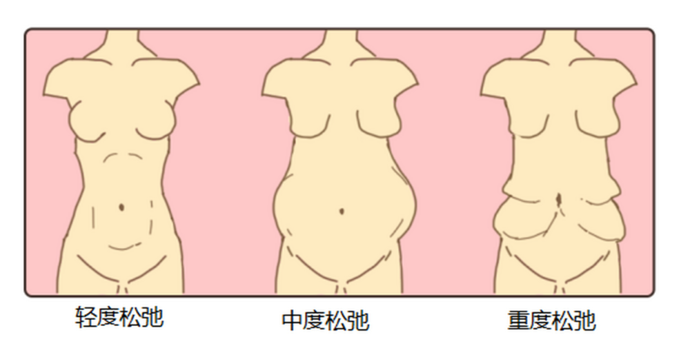 大连那位医生做腹壁整形手术怎么选？爱德丽格/瑞丽/徐医生三家技术对比更稳
