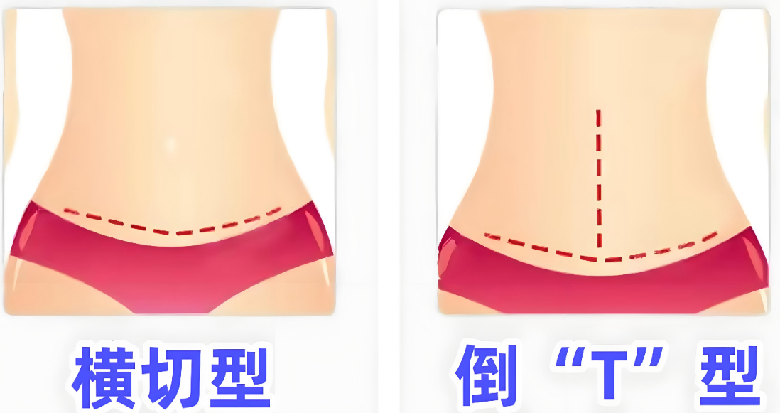 任杰腹壁整形预约费用解析，西安三甲医院服务更全面