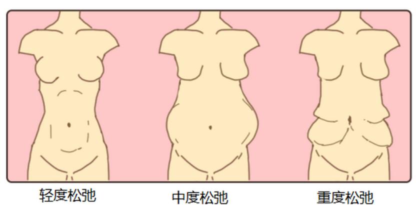 五、任杰腹壁整形预约费用注意事项