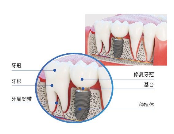 二、瑞典Astra种植牙的核心优势分析