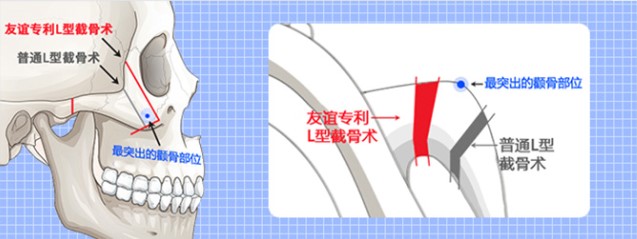 颧弓缩小手术的方法有哪些？2026年5种主流术式对比解析